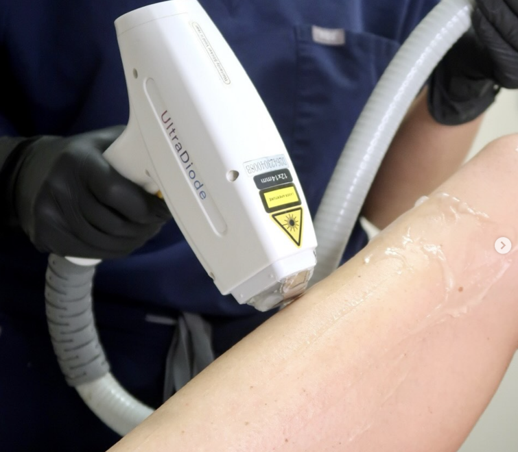 UltraDiode Laser Hair Removal