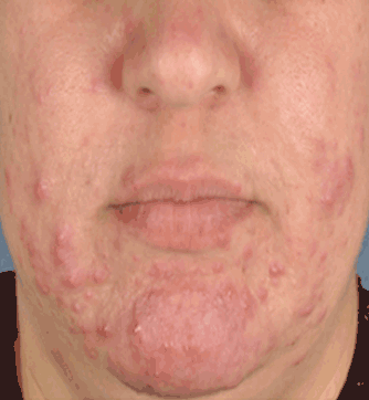 acne before