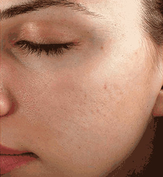 acne scars after