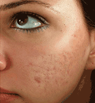 acne scars before